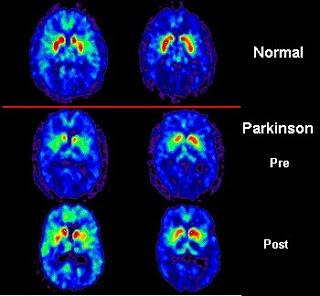 Maladie de Parkinson: ce qu’il faut savoir (UE 2.7 s4)